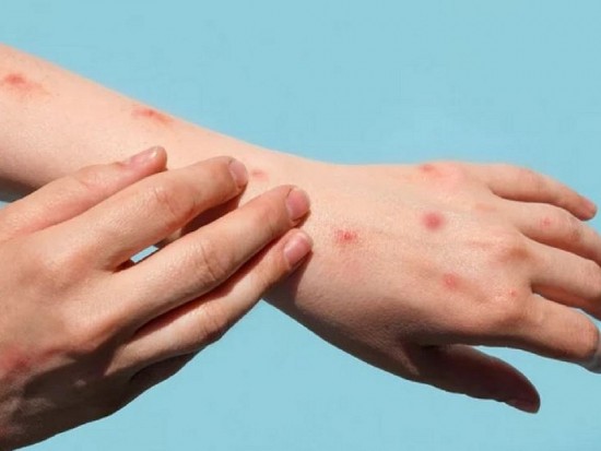 Việt Nam đang đẩy nhanh tiếp cận thuốc mới để điều trị bệnh đậu mùa khỉ